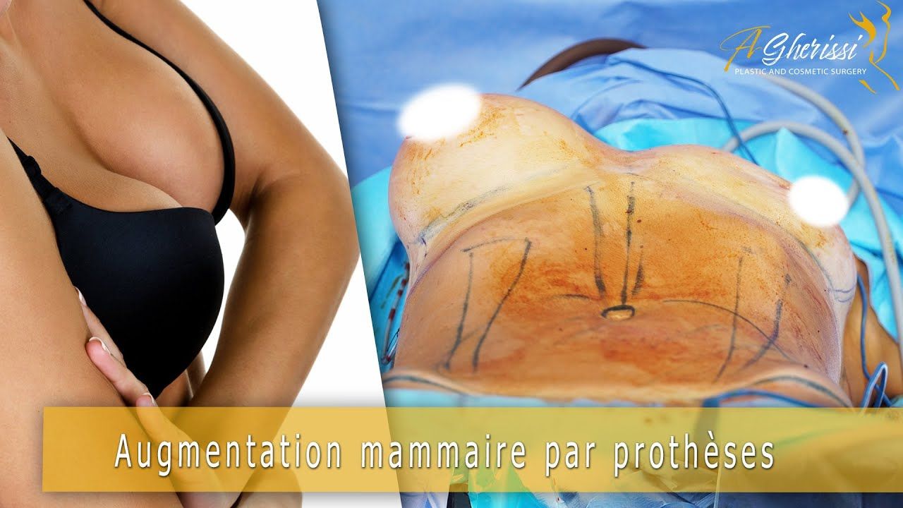 Lifting mammaire et augmantation mammaire 