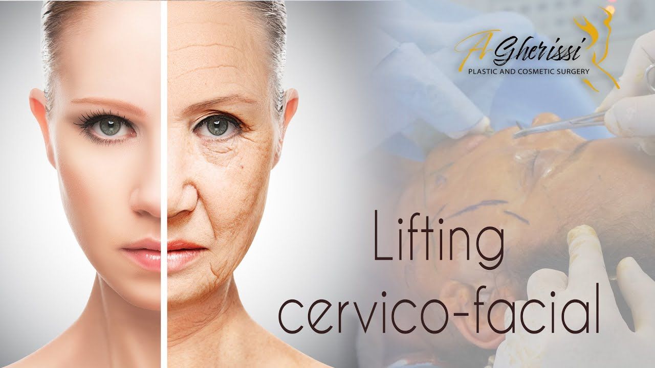 Lifting cervico-facial avec lifting temporal ou le lifting du visage associé à une blépharoplastie