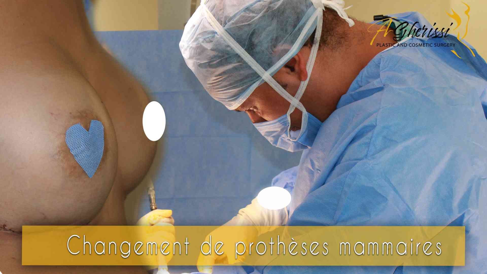 Changement de prothèses mammaires