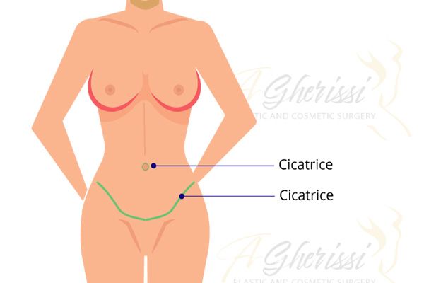 Schéma des cicatrices abdominoplastie
