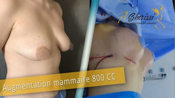 Augmentation mammaire par prothèses rondes de 800 cc