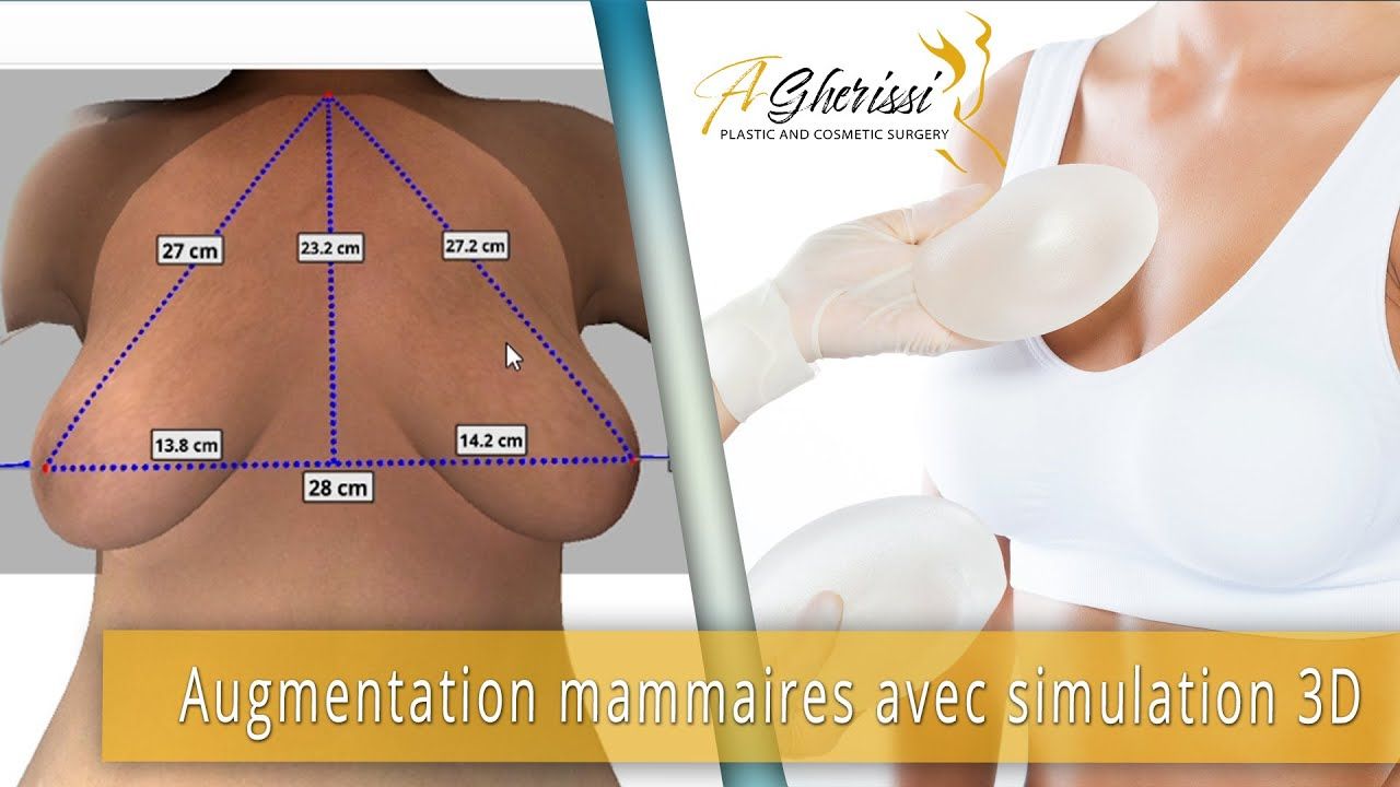 Augmentation mammaire avec simulation 3D crisalix